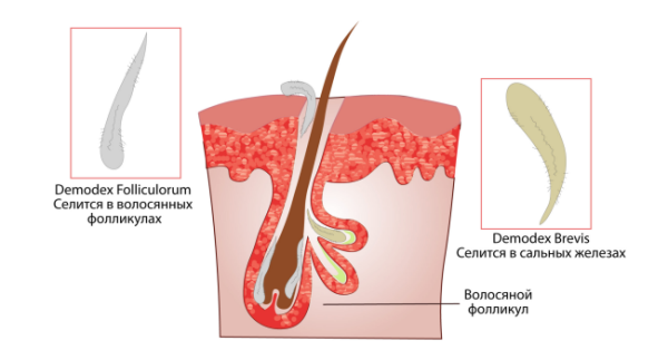 Что такое поверхностный фолликулит: варианты и способы лечения