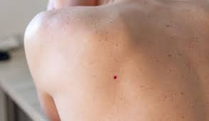 Чешется и не проходит бородавка на спине: советы и рекомендации