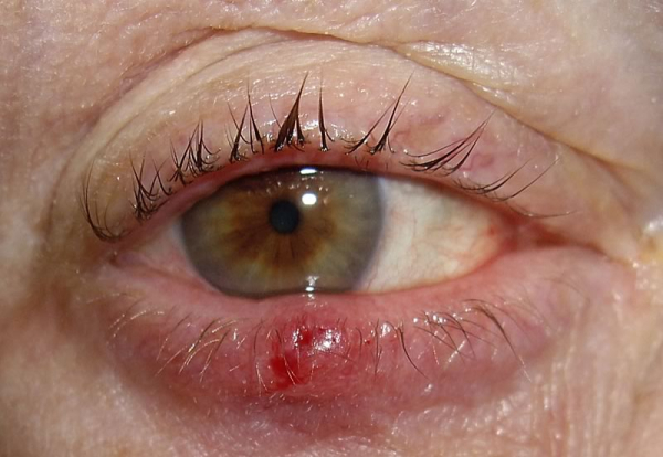 Трахома глаз: причины, симптомы, лечение и профилактика