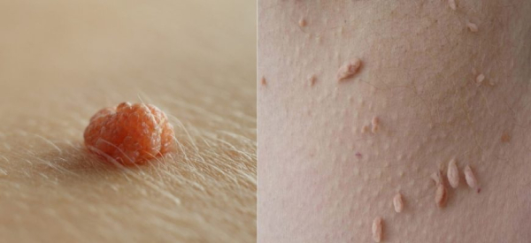 Папиллома увеличилась: диагностика и лечение