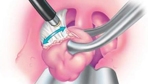 Сколько длится боль в горле после удаления папиллом?