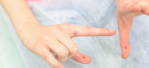 Бородавки на теле: причины появления и способы их лечения