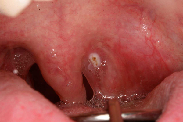 Папиллома на язычке в горле: симптомы и лечение