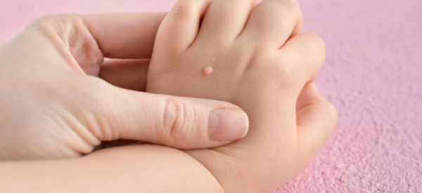 Виды бородавок у детей