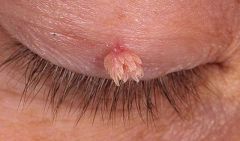 Лечение папиллом картошкой: противопоказания и рецепты