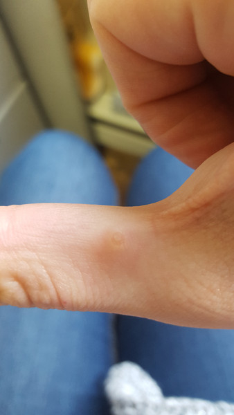 Бородавки на руках при беременности