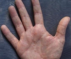 Как удалить папилломы на пальцах рук?