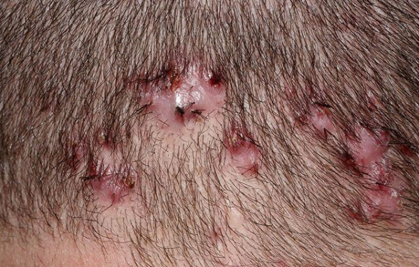 Как и чем лечить масляный фолликулит?