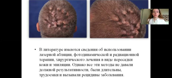 Подрывающий фолликулит Гофмана: причины, симптомы и лечение