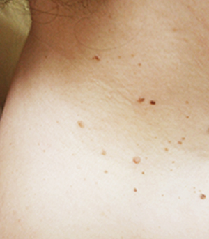 Особенности лечения папиллом в домашних условиях хозяйственным мылом