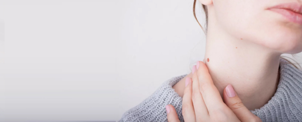 Как избавиться от висячих папиллом?