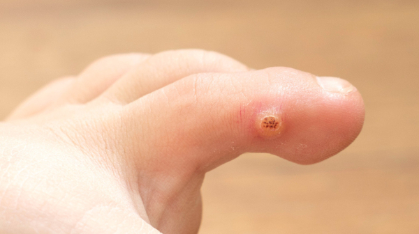 Как избавиться от папилломы на пальце ноги?