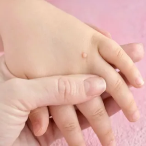 Бородавки на носу у ребенка: причины и лечение