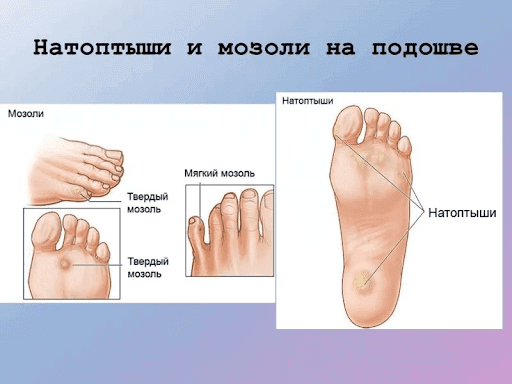 Сухие бородавки на ногах: симптомы и лечение