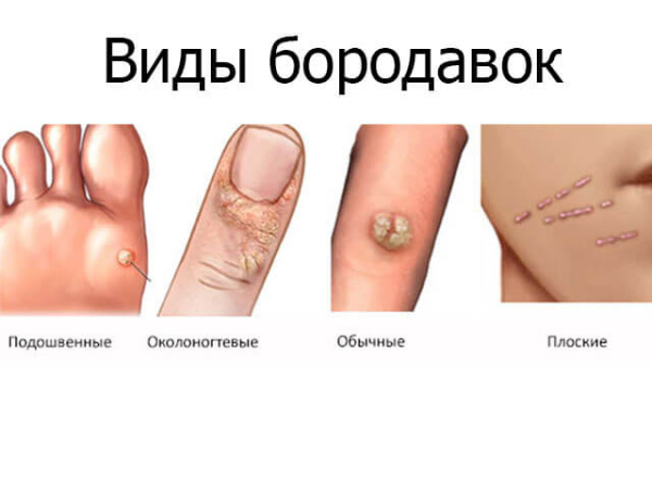 Виды бородавок у детей