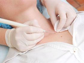 Уход после электрокоагуляции папиллом: основные рекомендации