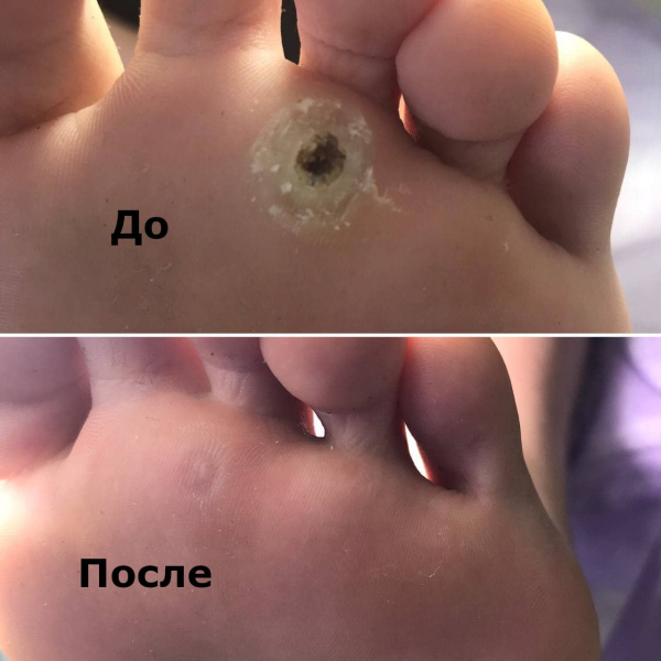 Что делать, если болит бородавка на пальце ноги?