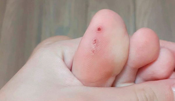 Как избавиться от папиллом с помощью чая?