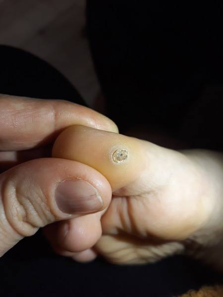 У ребенка почернела бородавка, что делать