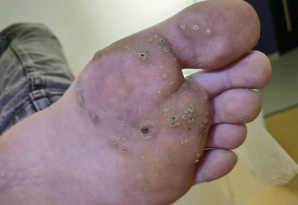 Отпала бородавка, что делать