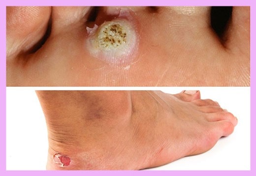 Как избавиться от куриной бородавки на ноге