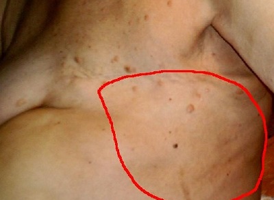 Можно ли перевязать папиллому ниткой: плюсы и минусы метода