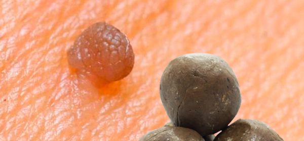 Лечение папиллом прополисом: рецепты и противопоказания