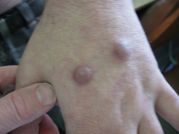 Споротрихоз у человека: пути инфицирования, симптомы, лечение