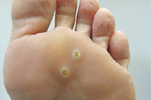 Плоская бородавка на ноге: причины и лечение