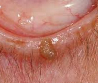Бородавка во рту: причины, симптомы и лечение