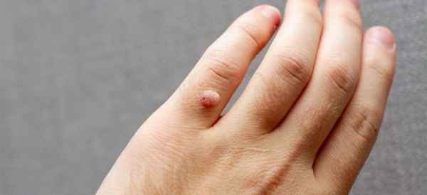 Удаление бородавок луком: рецепты приготовления