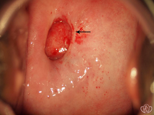 Что такое папиллома цервикального канала и как ее лечить?