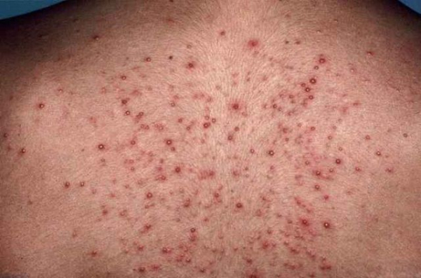 Что такое поверхностный фолликулит: варианты и способы лечения