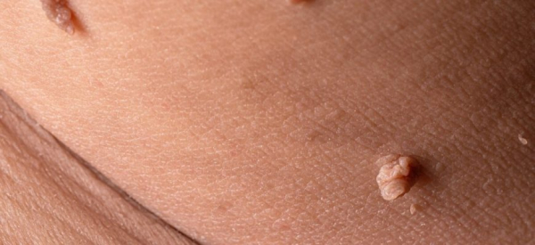 Как удалить папиллому под мышкой народными средствами?