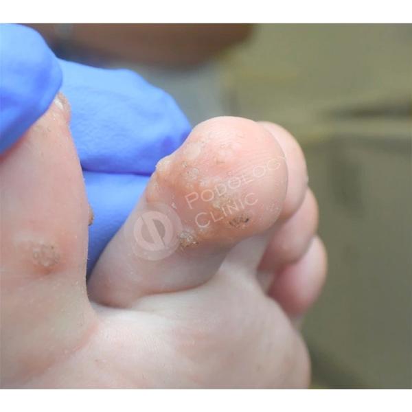 Куриные бородавки у детей