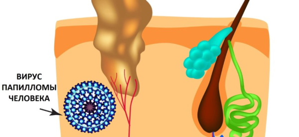 Папилломы на веках: лечение в домашних условиях народными средствами