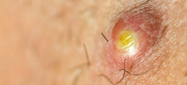 Карбункул: причины, симптомы, лечение и профилактика заболевания