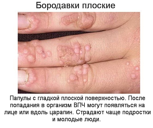 Чем отличается шипица от бородавки