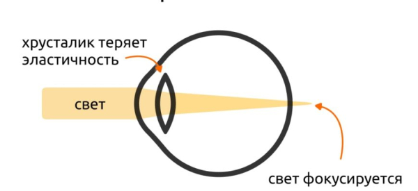 Пресбиопия: причины, симптомы, лечение, профилактика