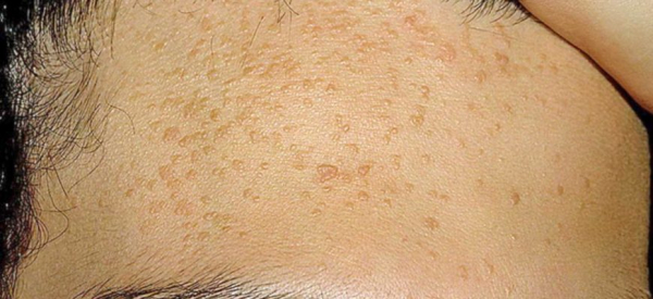 Как и чем лечить старческие папилломы?