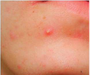 Бактериальный фолликулит: причины, симптомы и лечение