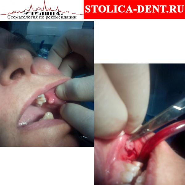 Как и чем лечить папилломы во рту?