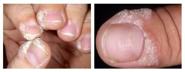 Вирусная бородавка на пальце руки: симптомы и лечение