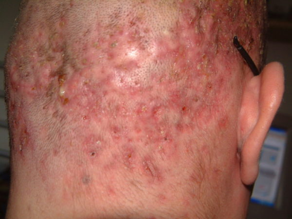 Сифилитический фолликулит: симптомы и лечение