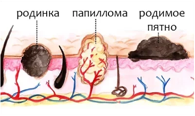 Невус и папиллома: в чем разница?