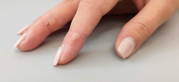 Не заживает рана после удаления бородавки