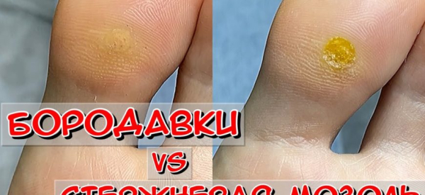 Как отличить стержневую мозоль от подошвенной бородавки