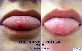 Как лечить бородавки на внутренней стороне губы