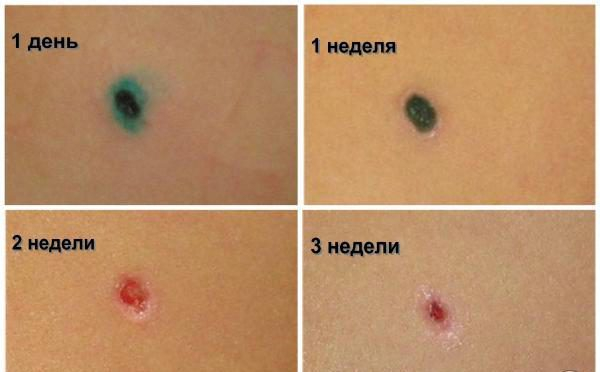 Уход за кожей после удаления папилломы лазером