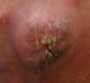 Бородавки на сосках при беременности: причины и лечение